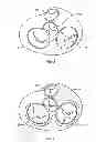 Fig. 04 - Method and apparatus for external stabilization of the heart