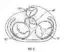 Fig. 05 - Method and apparatus for external stabilization of the heart