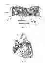 Fig. 06 - Method and apparatus for external stabilization of the heart