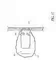 Fig. 49 - Diverticulum inverting device