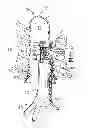 Fig. 01 - Treatment method including tissue occlusion device