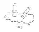 Fig. 35 - Catheter systems and related methods for mapping, minimizing, and treating cardiac fibrillation