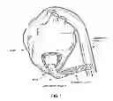 Fig. 02 - METHOD AND APPARATUS FOR SUTURELESSLY CONNECTING A CONDUIT TO A HOLLOW ORGAN
