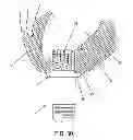 Fig. 30 - METHOD AND APPARATUS FOR SUTURELESSLY CONNECTING A CONDUIT TO A HOLLOW ORGAN