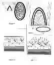 Fig. 05 - Ultimate bikini under pads (UBUP)