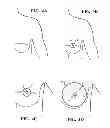 Fig. 03 - POST-NIPPLE RECONSTRUCTION PROTECTOR