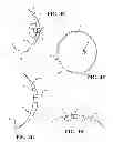 Fig. 04 - POST-NIPPLE RECONSTRUCTION PROTECTOR