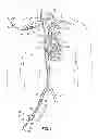 Fig. 02 - Two-piece transseptal cannula, delivery system, and method of delivery