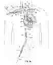 Fig. 20 - Two-piece transseptal cannula, delivery system, and method of delivery