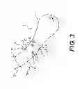 Fig. 04 - Suction catheter device and method