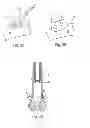 Fig. 04 - INNENKANT CATHETER TIP