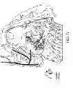 Fig. 13 - METHODS AND DEVICES FOR THE TREATMENT OF ATRIAL FIBRILLATION