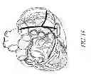 Fig. 16 - METHODS AND DEVICES FOR THE TREATMENT OF ATRIAL FIBRILLATION