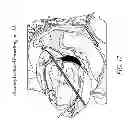 Fig. 19 - METHODS AND DEVICES FOR THE TREATMENT OF ATRIAL FIBRILLATION