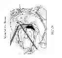 Fig. 21 - METHODS AND DEVICES FOR THE TREATMENT OF ATRIAL FIBRILLATION