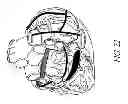 Fig. 24 - METHODS AND DEVICES FOR THE TREATMENT OF ATRIAL FIBRILLATION