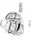 Fig. 25 - METHODS AND DEVICES FOR THE TREATMENT OF ATRIAL FIBRILLATION
