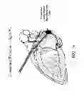 Fig. 26 - METHODS AND DEVICES FOR THE TREATMENT OF ATRIAL FIBRILLATION