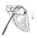 Fig. 30 - METHODS AND DEVICES FOR THE TREATMENT OF ATRIAL FIBRILLATION