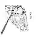 Fig. 31 - METHODS AND DEVICES FOR THE TREATMENT OF ATRIAL FIBRILLATION