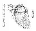 Fig. 34 - METHODS AND DEVICES FOR THE TREATMENT OF ATRIAL FIBRILLATION