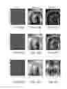 Fig. 43 - Methods and systems for optimizing lesion placement to minimize and treat cardiac fibrillation