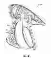 Fig. 12 - Limited-use medical device