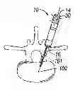 Fig. 01 - Hand held integrated pedicle screw placement device