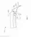 Fig. 08 - FISTULA TREATMENT DEVICES AND METHODS