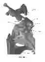 Fig. 131 - Systems and methods for fusing a sacroiliac joint and anchoring an orthopedic appliance