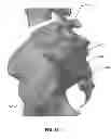 Fig. 136 - Systems and methods for fusing a sacroiliac joint and anchoring an orthopedic appliance
