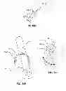 Fig. 22 - Systems and methods for fusing a sacroiliac joint and anchoring an orthopedic appliance