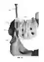 Fig. 76 - Systems and methods for fusing a sacroiliac joint and anchoring an orthopedic appliance