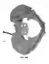 Fig. 77 - Systems and methods for fusing a sacroiliac joint and anchoring an orthopedic appliance