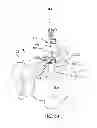 Fig. 85 - Systems and methods for fusing a sacroiliac joint and anchoring an orthopedic appliance