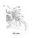 Fig. 99 - Systems and methods for fusing a sacroiliac joint and anchoring an orthopedic appliance