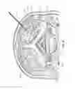 Fig. 45 - NEUROSTIMULATION SYSTEM