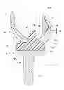 Fig. 01 - Artificial knee joint