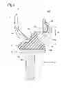 Fig. 03 - Artificial knee joint