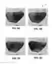 Fig. 05 - Phase values and wave front detection for electrophysiological cardiac signals