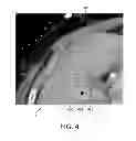 Fig. 05 - Ablation planning system