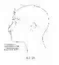 Fig. 45 - Patient interface device