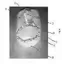 Fig. 09 - Exfoliating Foot Covering