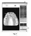 Fig. 08 - Dental occlusion analysis tool