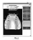 Fig. 09 - Dental occlusion analysis tool