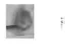 Fig. 08 - Stromal Derived Factor Inhibition And CXCR4 Blockade
