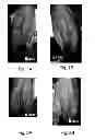 Fig. 02 - PROSTAGLANDIN COMPOSITIONS AND METHODS FOR THE TREATMENT OF VASOSPASM