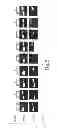 Fig. 07 - METHODS AND COMPOSITIONS FOR DETECTING CANCERS ASSOCIATED WITH METHYLATION OF HMLH1 PROMOTER DNA