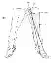 Fig. 01 - Penis extender