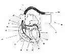Fig. 01 - Device and method for fusion beat detection